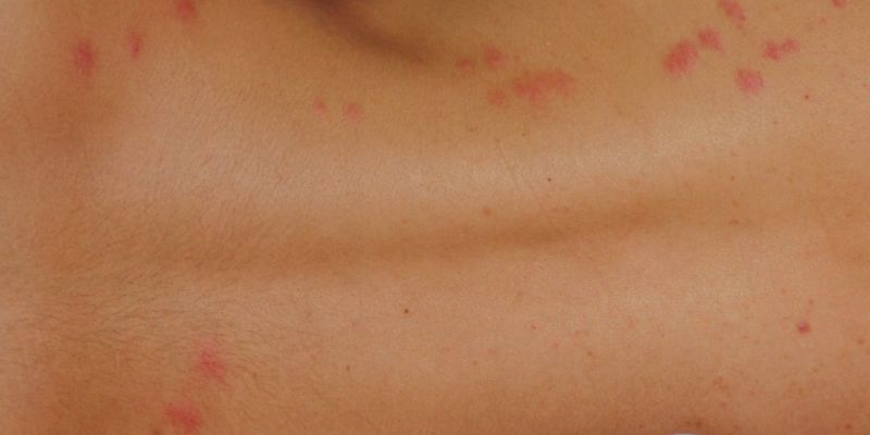 comment se protéger des punaises de lit
